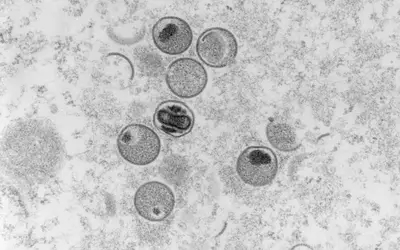 DF registra primeiro caso suspeito de varíola dos macacos